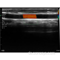 Superweiten linearer Ultraschallscanner für Brustinspektion